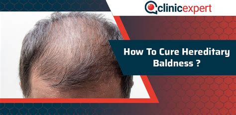 How To Cure Hereditary Baldness Clinicexpert