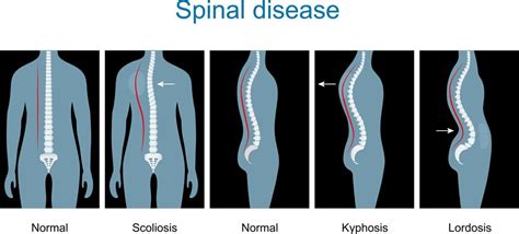 Lordosis Kifosis Dan Skoliosis Apa Bedanya