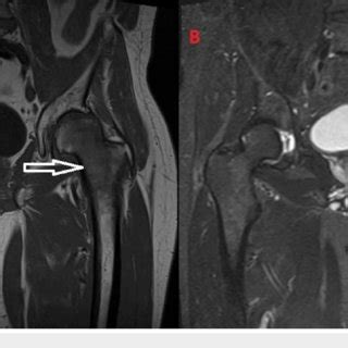 (A) T1-weighted images and (B) T2-weighted images from the MRI of the ...