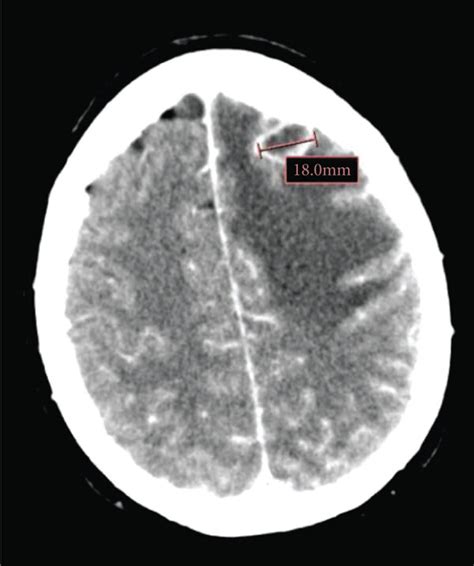 Image Of Left Frontal Lobe Lesion From CT Scan At Diagnosis A And