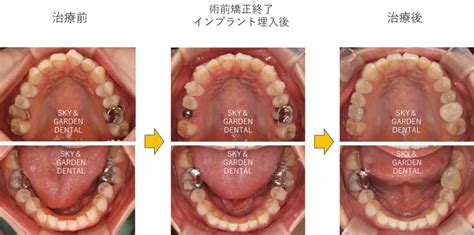 インビザライン術前矯正後に上顎大臼歯インプラント1本埋入症例 武蔵浦和駅の歯医者 スカイ＆ガーデンデンタルオフィス武蔵浦和駅の歯医者
