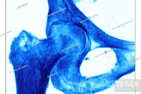 Tridimensionnal Mri Of A Right Hip Normal 3d Mri Of The Femur Neck In