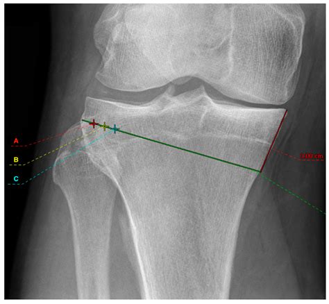 Influence Of Medial Osteotomy Height And Hinge Position In Open Wedge