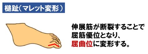 関節リウマチについて正しいのはどれか【第53回理学療法士国家試験am87】 — 理学療法士国家試験対策ptes