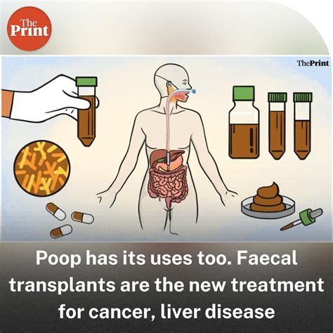 Theprintindia On Twitter The Procedure Used In Several Hospitals