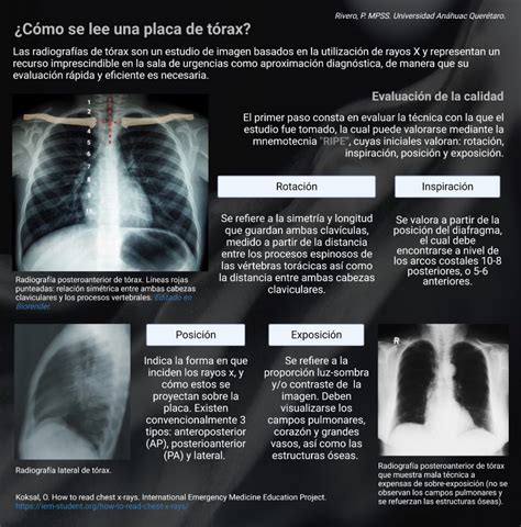 Radiograf A De T Rax Qu Es Y D Nde Obtener Una En Salud Digna