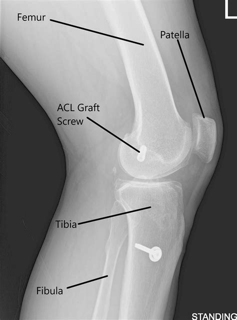 Case Study Chondroplasty Of Left Knee In 63 Yr Old Female