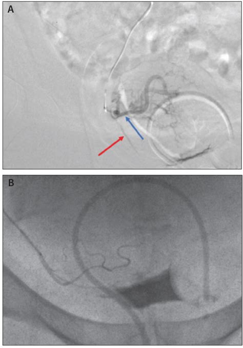 Uterine Artery Embolization Endovascular Today