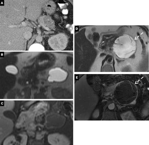 Atypical Serous Cystadenoma And Mucinous Cystadenoma Patient With A