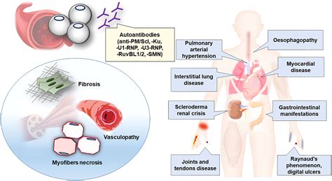 Frontiers Scleromyositis A Distinct Novel Entity Within The Systemic Sclerosis And Autoimmune