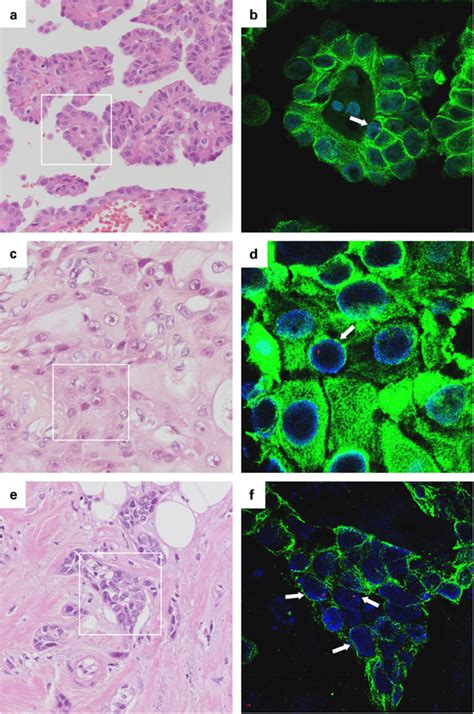 Y Positive Epithelial Cells In Carcinomas From Three Female Recipients Download Scientific