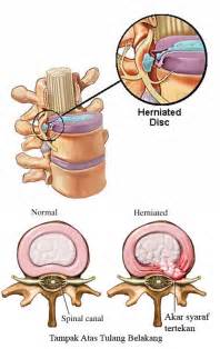 Nyeri Pinggang Dan Herniated Nucleus Pulposus Hnp Rsi Aisyiyah Malang