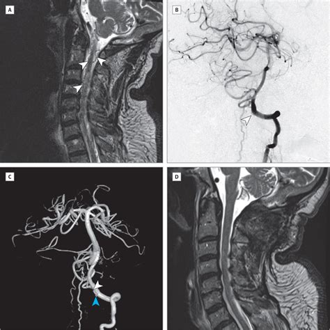 Paraparesis From Upper Cervical Spinal Dural Arteriovenous Fistula