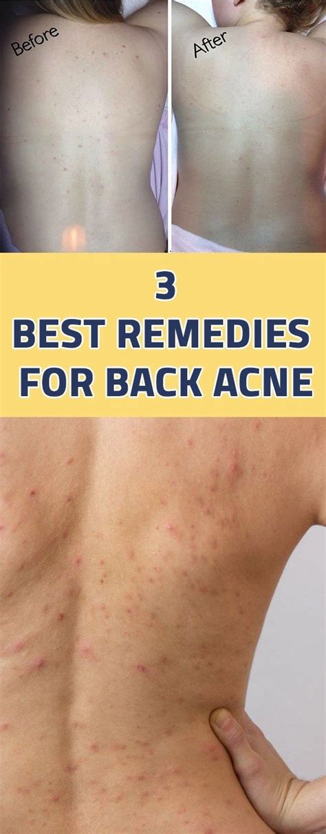 3 Best Remedies For Back Acne Healthy Beauty Ways Back Acne Remedies Back Acne Treatment