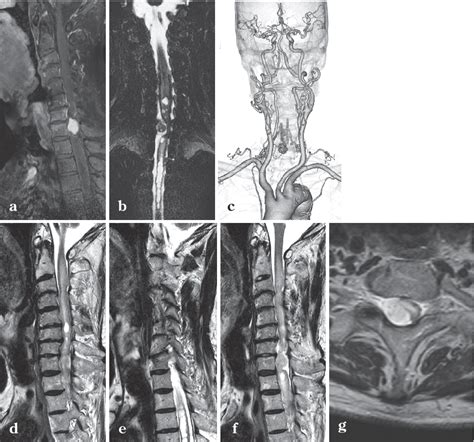 Figure 1 From Spinal Capillary HemangiomaCoexistent Spinal Edema And