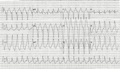 Right Ventricular Outflow Tract Tachycardia (RVOT) | ECG Guru ...