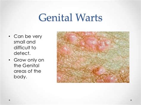 Warts