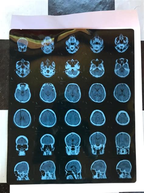 Hasil Ct Scan Hellosehat