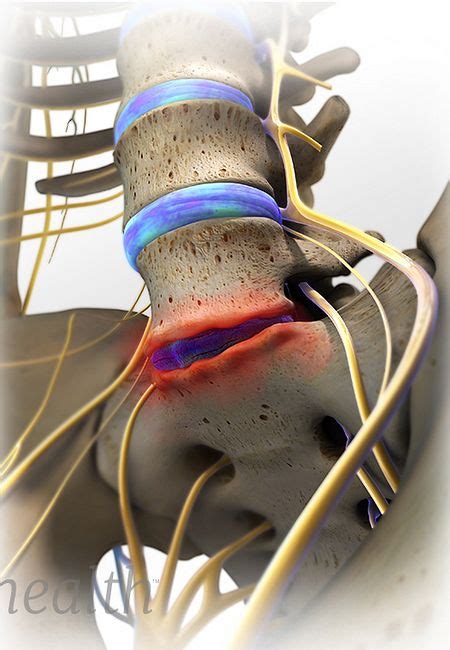 Degenerative Disc Disease Treatment for Low Back Pain