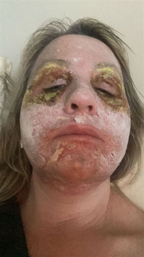 Beauty Addict Left With Beetlejuice Scabby Face From 1 800 Treatment