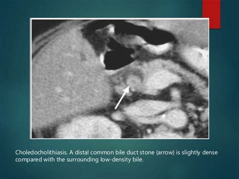 Imaging Of Obstructive Jaundice