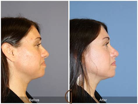 Tip Rhinoplasty Before After Photos From Dr Kevin Sadati