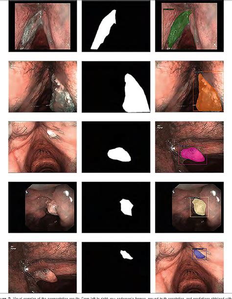 Figure 3 From Instance Segmentation Of Upper Aerodigestive Tract Cancer Site Specific Outcomes