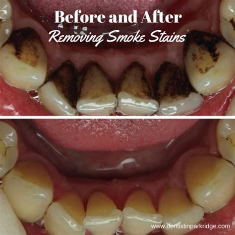 Pin On Davis And Engert Dentistry Before And After