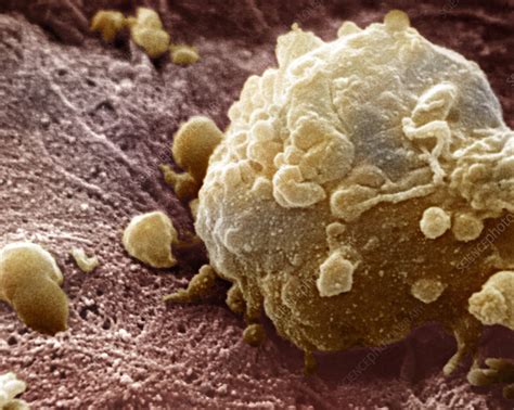 Melanoma Cell Stock Image M132 0979 Science Photo Library