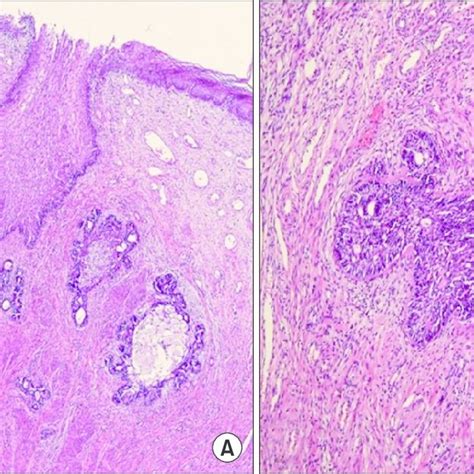 A Low Power View Of Rounded Nests Of Basaloid Cells Infiltrating The