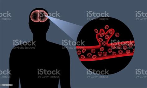 Brain Stroke Hemorrhagic Stock Illustration Download Image Now Accidents And Disasters