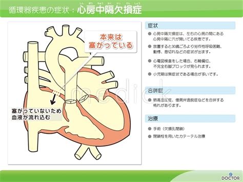 心房中隔欠損の説明スライド 医療のイラスト・写真・動画、素材販売サイトのメディックmedick