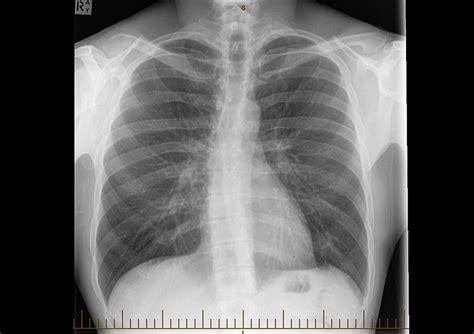 Pulmonary Fibrosis Diagnosis and Treatment | Lung and Sleep