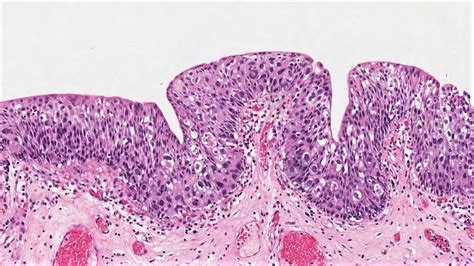 Células uroteliales MyPathologyReport ca