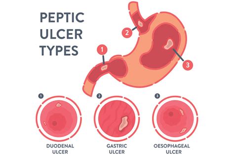 Pepticgastriculcers Treatment In Anand