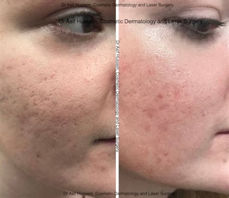 Acne Scar Laser Treatment Removal London Dr H Consult