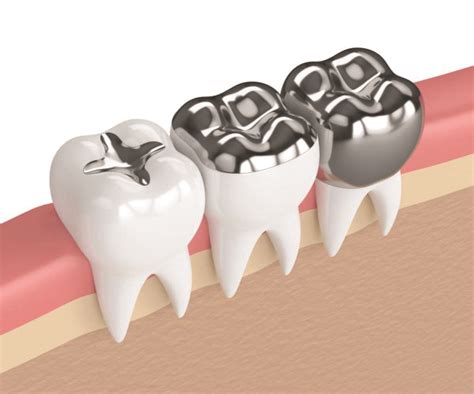 Amálgama na odontologia entenda sobre 100fronteiras