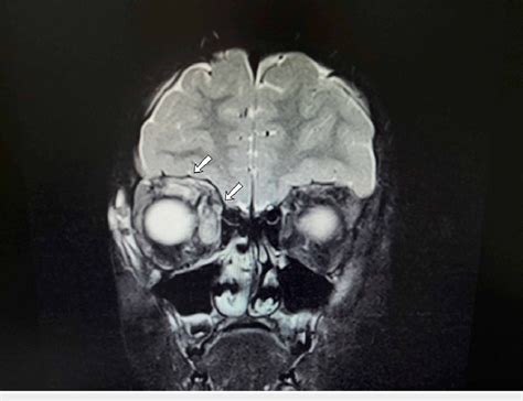 Coronal Mri Orbits With Gadolinium Showing Enhancing Thickened Right