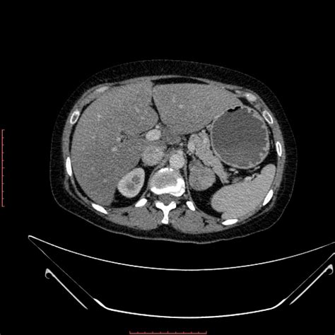 Adrenocortical Adenoma Image