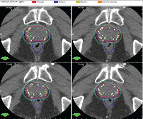 Figure 2 Permanent Seed Brachytherapy This Image Urologic