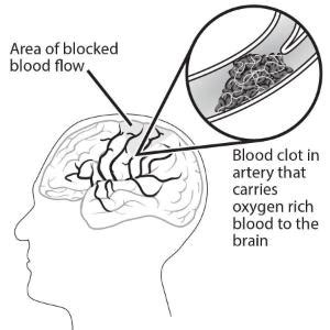 Science Take-Out® Testing A Clot Buster | Ward's Science