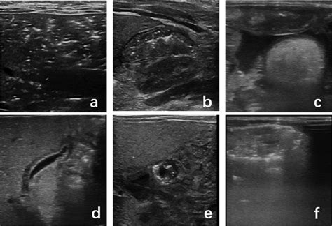 Differentiation of food protein-induced enterocolitis syndrome and ...