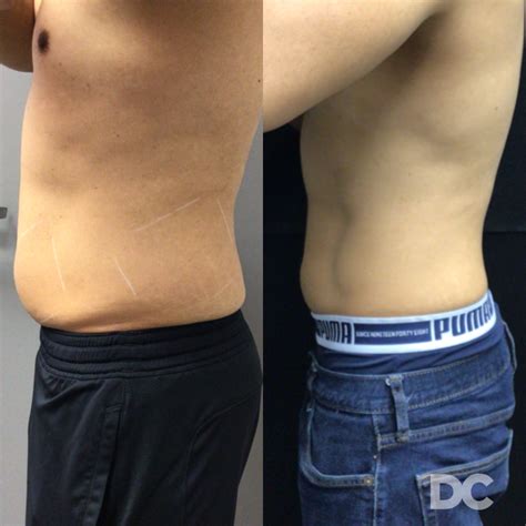 Trusculpt® 3d Fat Reduction Body Contouring Winnipeg Victoria Park