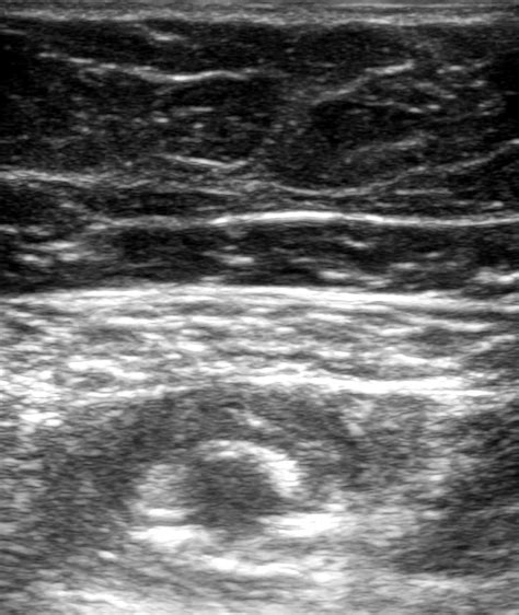 PNBschool.com/ Learn ultrasound guided adductor canal blocks