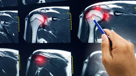 Subacromial Spacer Balloon As Good As Partial Rotator Cuff Repair