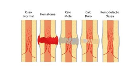 Fratura Osso Cola mais Forte ou Fraco Medicina Ortopédica