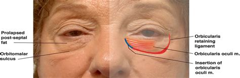 lysis   orbicularis retaining ligament  orbicularis