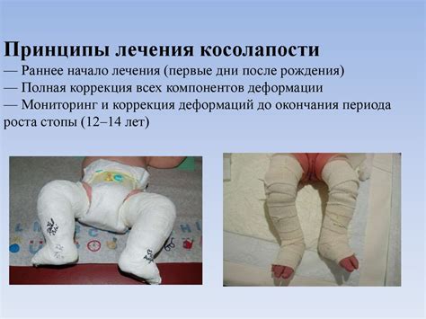 Врожденная косолапость - online presentation