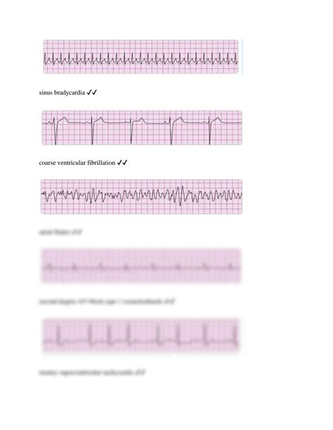 Solution Acls Rhythm Strips Studypool