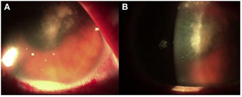 Frontiers Case Report Molecular Diagnosis Of Fungal Keratitis Associated With Contact Lenses